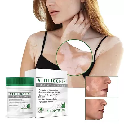 Vitiligo Fix Revitalize Elixir Treatment Cream Treat Vitiligo Soothing Cream • $7.29