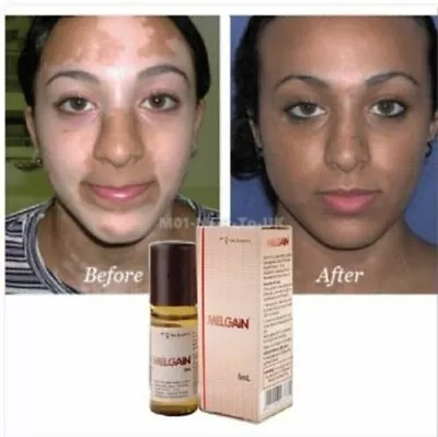 PACK OF 2 X Melgain Lotion For Vitiligo White Spots Patches 5ml Free Shipping • $23.99