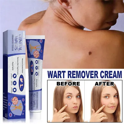 UK Wart Remover Cream Repair Safely Remove Feet Facial Genital Warts Tags&Corns • £3.46