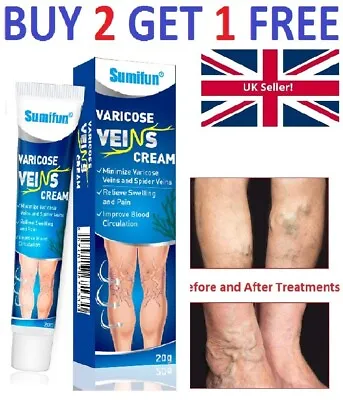 Varicose Veins Vasculitis Legs Treatment Cream Gel Phlebitis Itchy Raynaud's • £5.99