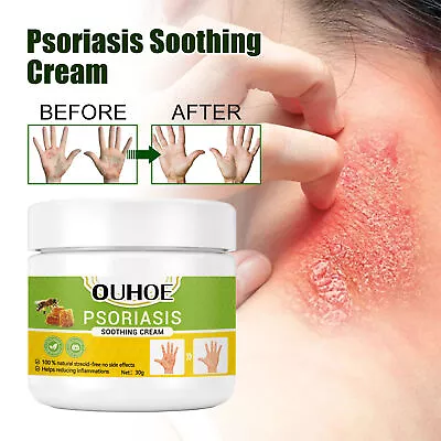 1/2/3PCS Psoriasis Cream Dermatitis Eczema Ointment Healing Antibacterial Cream • $5.95