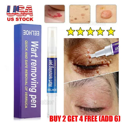 Unisex 12 Hours Wart Remover Pen Skin Tag Mole Remover Eliminate Foot Corn Warts • $8.50