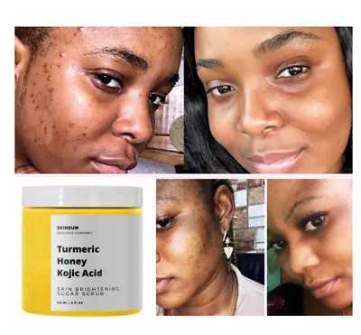 $14.99 • Buy Skin Whitening Dark Spots Lightening Acne Brightening Turmeric Honey Kojic Acid