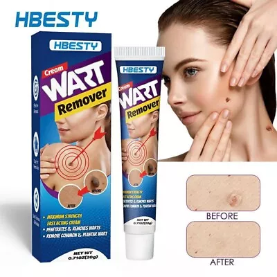HBESTY Wart Removal Ointment | Easy-to-Use | Fast Results | Bestselling Care Sol • £5.99