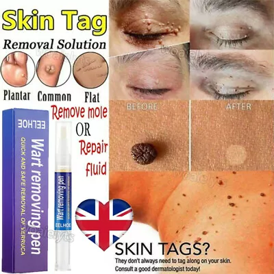 Wart Remover Pen Skin Tag Removal Treatment Cream Face Care Mole Corn Natural UK • £6.45