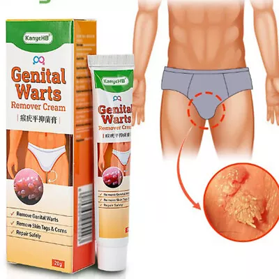 20g Genital Herpe Wart Remover Ointment Skin Tag Mole Acuminatum Treatment NEW • £4.22