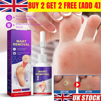 NEW Foot Corn Removal Liquid | Painless Treatment | Genital Warts Calluses UK • £5.99