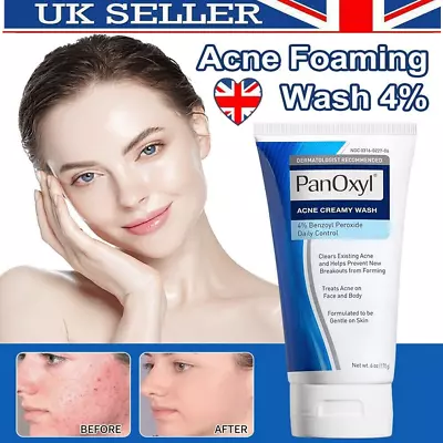 Acne Foaming Wash Face & Body 10% Active Ingredient 156g New UK • £8.49