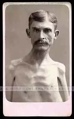 Extremely Rare Sideshow Freak Photo Skeleton Man Possibly OOAK Eisenmann Test • $1250