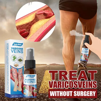 5-1xVein Healing Varicose Veins Treatment Spray Veinhealing Varicose Veins Spray • $10.45