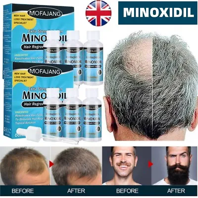 £23.95 • Buy Hair Regrowth Treatment For Men 5% Extra Strength Hair Growth Regain Solution UK