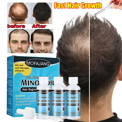 £23.95 • Buy Hair Regrowth Treatment For Men 5% Extra Strength Growth Solution Anti Hair Loss
