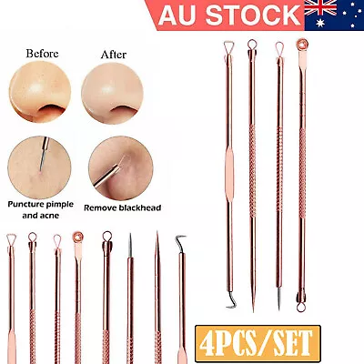 $4.46 • Buy 4PCS/SET Blackhead Remover Tool Pimple Pore Blemish Comedone Acne Cleaner Kit