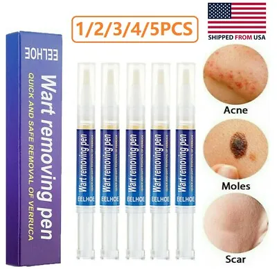 1-5PCS 12 Hours Wart Remover Pen Skin Tag Mole Remover Eliminate Foot Corn Warts • $9.09
