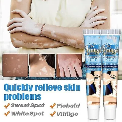 Vitiligo White Spot Treatment Cream Relief Herbal Ointment Skin Repair 20g X3 • $21.19