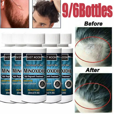 £23.95 • Buy 9PC Hair Regrowth 5% Extra Strength Topical Hair Loss Treatment For Men Solution