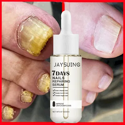 Nail Repair Serum Fungus Toe Nail Fungus Treatment Onychomycosis Remover 20ml • $9.28