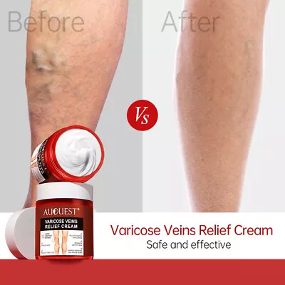 Varicose Veins Relief Cream Vasculitis Phlebitis Pain Relief Ointment Plaster • £7.76