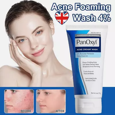 New Acne Foaming Wash Face & Body 156g Peroxide All Skin Types 5.5oz • £6.05
