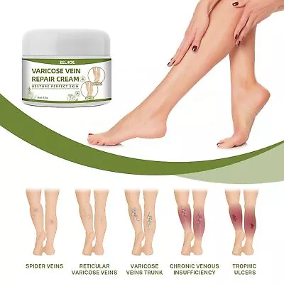 Ointment Vein Care Fading Cream Legs Varicose Veins Cream Vasculitis Treatment • £4.31