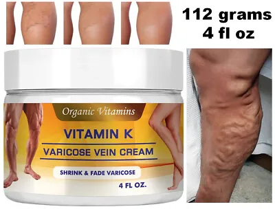 Vein Varicose Veins Support Cream  Spider Leg Massage Crema Legs Vitamin K Scars • $10.95