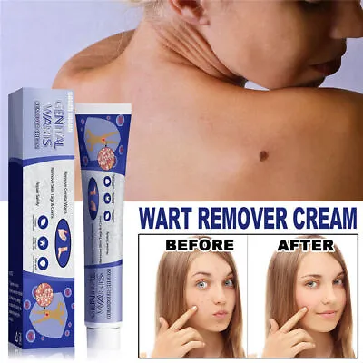 Wart Remover Cream Repair Ointment Remove Feet Facial Genital Warts Tags Corns • £6.55