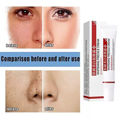 Whitening Freckle Cream Face Moisturizing Remove Dark Spots Melanin Melasma NEW • $5.99