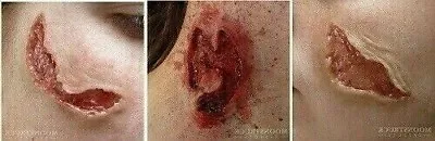 Zombie Scar Wounds FX Gelatin Prosthetic Latex Free Halloween Makeup SFX Effects • £12.99