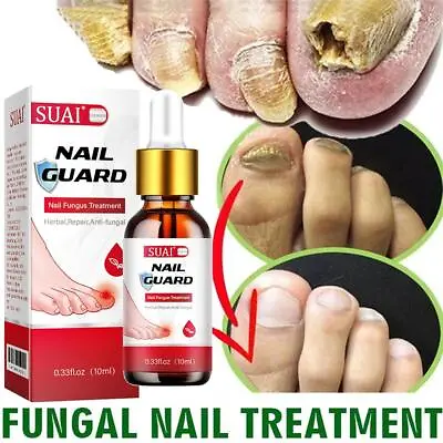 Nail Fungal Treatment Oil Serum Anti Infection Toe Fungus Removal Rep Sell • $2.77