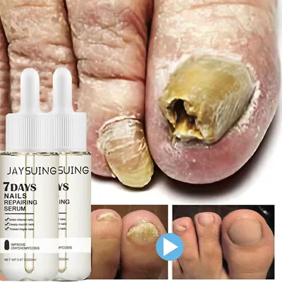 Nail Repair Serum Fungal Nail Treatment Liquid Remove Toe Nail Fungus Essence • $18.28