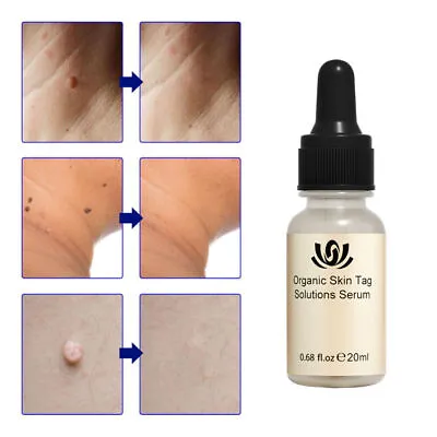 12 Hours 20ml Wart Remover Skin Tag Mole Remover Eliminate Foot Corn Wart Liquid • £5.08