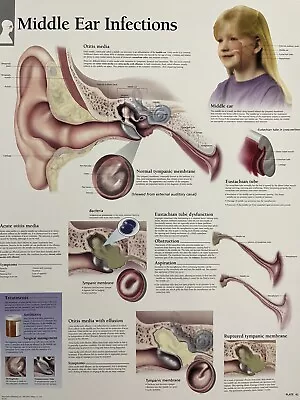 Scientific Publishing ~ Middle Ear Infections ~ Anatomy Poster 12 X 16 Inches • $10