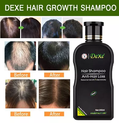 200ml Dexe Fast Hair Growth Shampoo Anti Hair Loss Hair Thickening For Women Men • £24.95