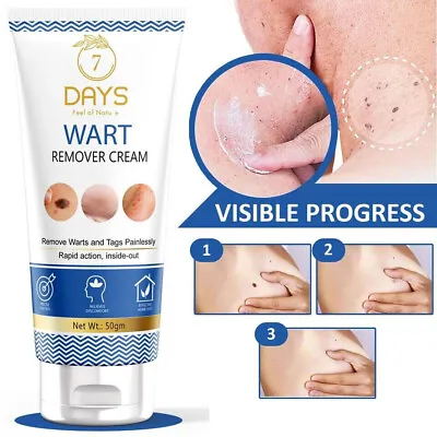 Genital Wart Removal Treatment Cream. Discreet Free Packaging Included 50g. • £14.75