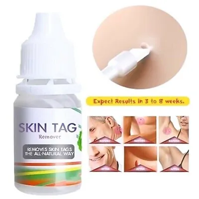 Wart Remover Skin Tag Remover Spot Mark Remover Genital Wart Remover - UK Seller • £4.79