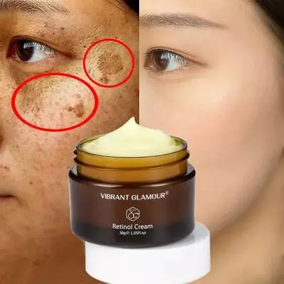 $7.77 • Buy Whitening Cream Retinol Removes Melasma Acne Spots Pigment Dark Spots Pigment