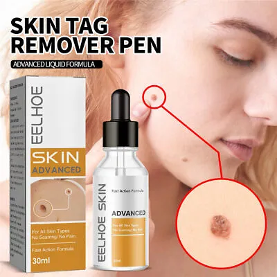 Wart Removal Remover Treatment Essences Skin Tag Common Genital Warts Plantar • £7.59