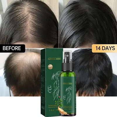 100ML Ginseng Hair Growth Solution Hair Regrowth Serum Spray Anti-Loss Treatment • £7.45