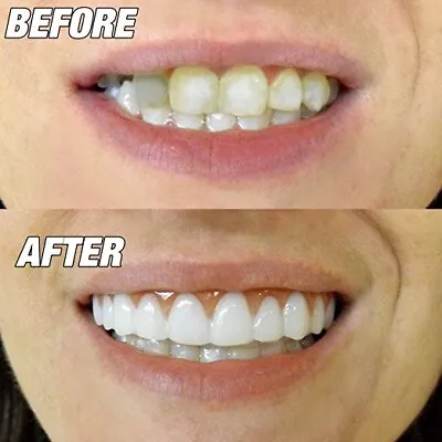 Instant Smile Comfort Fit Flex Teeth Top Cosmetic Veneer One Size Fits Most • $24.99