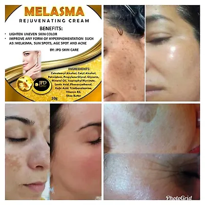 Melasma Rejuvenating Whitening Cream Remove Dark Spot • $8