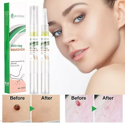 2PCS Painless And Safe Skin Tag Removal Pen Skin Tag Mole Wart Black Spot Remove • $8.59