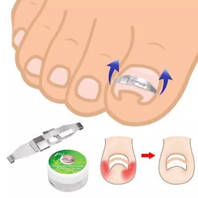 Health Care Paronychia Ingrown Toenail Straightener Correction Pedicure Tools • $7.34