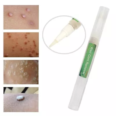 Skin Tag Removal Treatment Cream Face Care Mole Corn Wart Remover Natural Pen • £4.95