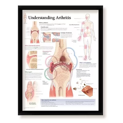 Understanding Arthritis Framed Medical Informational Poster 22x28 Wall Diagram • $65.99