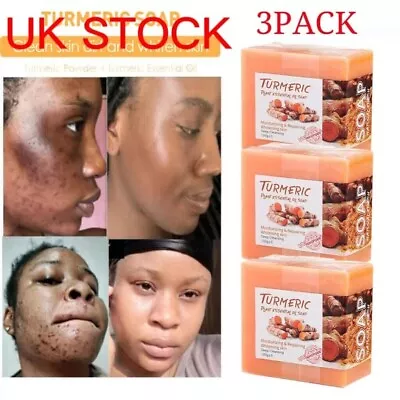 3Pack Tumeric Soap Acne Dark Spots Remove Skin Whitening Body Bleaching Soap UK • £8.85