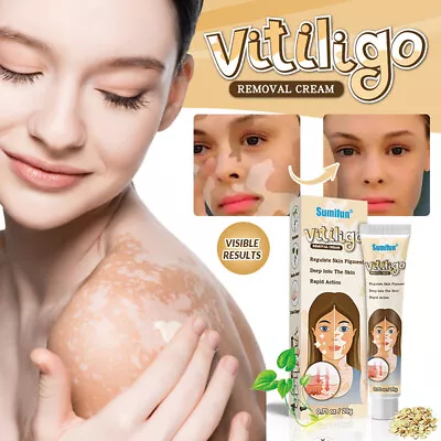 Treatment Moisturizing Cream White Spot Disease Vitiligo Balm Repair Ointment • $2.74