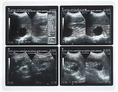 Genuine Vintage Hospital Human X-Ray Ultrasound Scan Original Acetate Film • £38