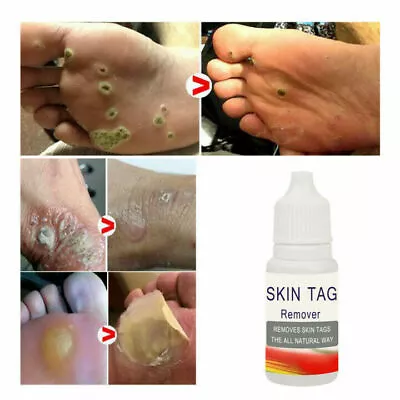 2X Tag Removal Skin Treatment Cream Face Care Mole Remover Wart Remover Natural • £4.01