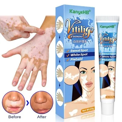 Vitiligo Leukoplakia Herbal Treatment Ointment White Spot Patch Repair Cream 20g • $7.59