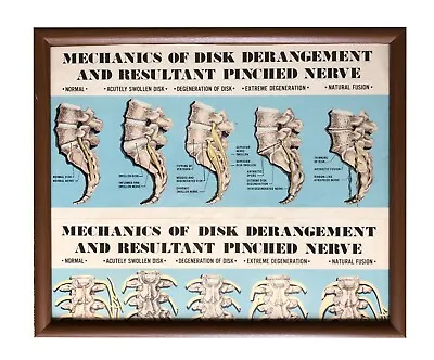 Vintage Framed Medical Chiropractic Poster Disk Spine Derangement Pinched Nerve • $49.99